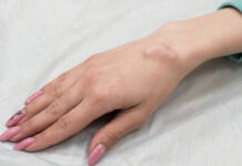 Is It a Ganglion or a Synovial Cyst? The 2 Subtle Differences You (and Your Doctor) Might Miss Is It a Ganglion or a Synovial Cyst