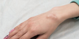 Is It a Ganglion or a Synovial Cyst? The 2 Subtle Differences You (and Your Doctor) Might Miss Is It a Ganglion or a Synovial Cyst