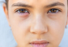 What Is a Chalazion? Symptoms, Causes & How It’s Treated What Is a Chalazion