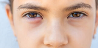 What Is a Chalazion? Symptoms, Causes & How It’s Treated What Is a Chalazion