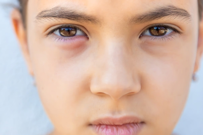 What Is a Chalazion What Is a Chalazion