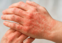 When Dry Skin Turns Dangerous: How to Spot and Treat an Infection When Dry Skin Turns Dangerous How to Spot and Treat an Infection