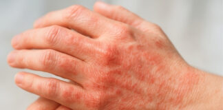 When Dry Skin Turns Dangerous: How to Spot and Treat an Infection When Dry Skin Turns Dangerous How to Spot and Treat an Infection