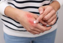 It’s Been 6 Months: Why Your ‘Margarita Burn’ Is Still Purple—and How to Fade the Stubborn Hyperpigmentation Safely Why Your ‘Margarita Burn’ Is Still Purple