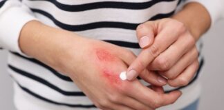 It’s Been 6 Months: Why Your ‘Margarita Burn’ Is Still Purple—and How to Fade the Stubborn Hyperpigmentation Safely Why Your ‘Margarita Burn’ Is Still Purple