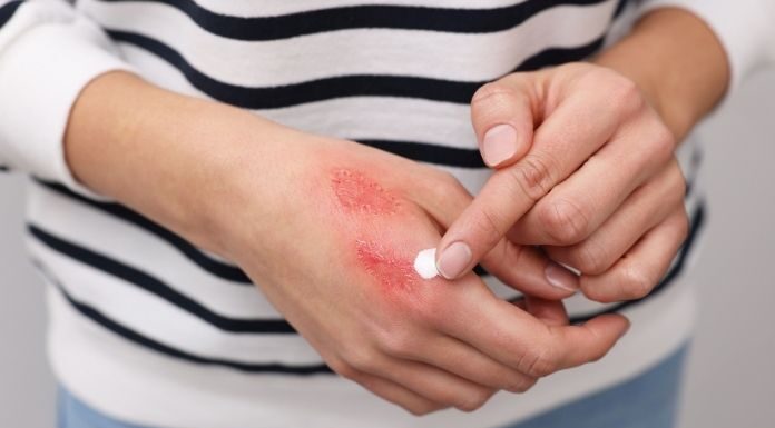 It’s Been 6 Months: Why Your ‘Margarita Burn’ Is Still Purple—and How to Fade the Stubborn Hyperpigmentation Safely Why Your ‘Margarita Burn’ Is Still Purple