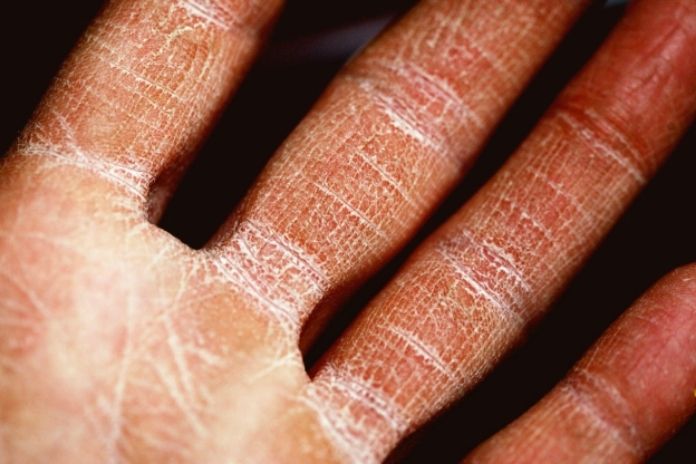 Effects of Vitamin A Toxicity on Skin Barrier