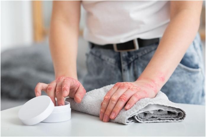 Integrating Bleach Baths Into an Eczema Care Routine
