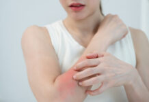 Is It Cellulitis or a Plant Burn? 5 Signs Your Doctor Might Be Misdiagnosing Your Blistering Rash Is It Cellulitis or a Plant Burn