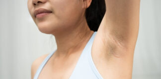 The Wedding Prep Guide: Can You Fade Acanthosis Nigricans Fast? The Wedding Prep Guide Can You Fade Acanthosis Nigricans Fast