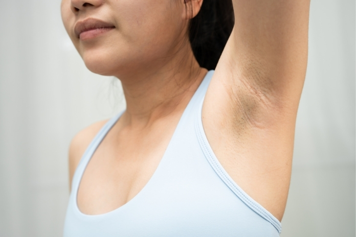 The Wedding Prep Guide Can You Fade Acanthosis Nigricans Fast The Wedding Prep Guide Can You Fade Acanthosis Nigricans Fast