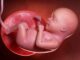What Is a Bicornuate Uterus? Causes, Diagnosis, and What It Means for Pregnancy What Is a Bicornuate Uterus