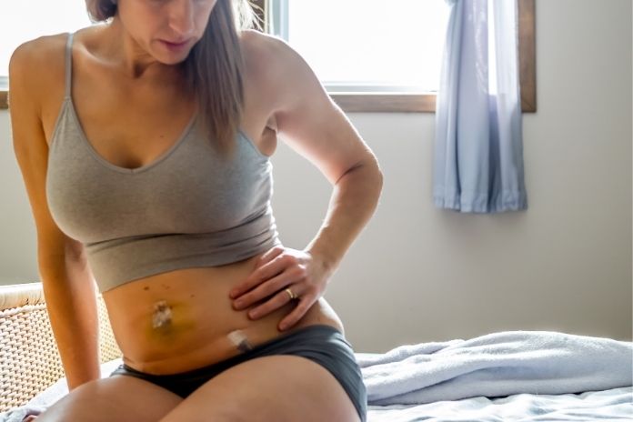 Why Iron Deficiency Happens After Gastric Bypass