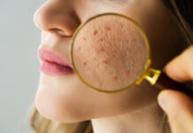 How to Treat “Chicken Skin” Scars and Hyperpigmentation (Without Picking) How to Treat Chicken Skin Scars and Hyperpigmentation