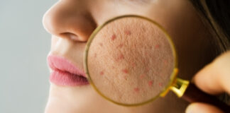 How to Treat “Chicken Skin” Scars and Hyperpigmentation (Without Picking) How to Treat Chicken Skin Scars and Hyperpigmentation