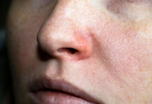 Is Your Facial Redness Keratosis Pilaris Rubra? How to Tell and What Helps Is Your Facial Redness Keratosis Pilaris Rubra