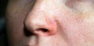 Is Your Facial Redness Keratosis Pilaris Rubra? How to Tell and What Helps Is Your Facial Redness Keratosis Pilaris Rubra