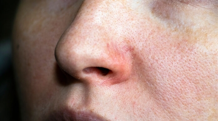 Is Your Facial Redness Keratosis Pilaris Rubra? How to Tell and What Helps Is Your Facial Redness Keratosis Pilaris Rubra
