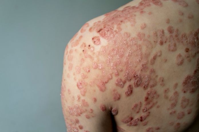 Other Triggers Besides Strep Throat