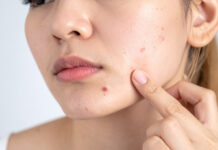 Painful Jawline Pimples: Why Hormones Often Target Your Lower Face Painful Jawline Pimples Why Hormones Often Target Your Lower Face