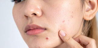 Painful Jawline Pimples: Why Hormones Often Target Your Lower Face Painful Jawline Pimples Why Hormones Often Target Your Lower Face