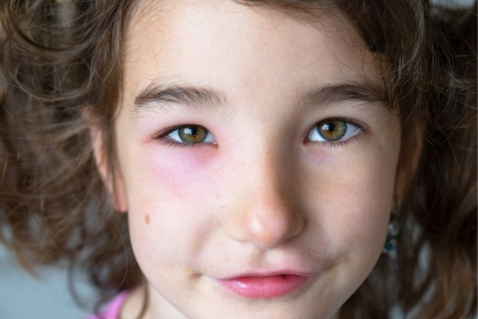 Signs of Prader-Willi Syndrome Signs of Prader-Willi Syndrome