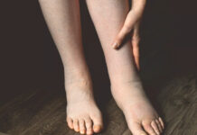 Swollen Legs and Ankles: When It’s a Heart Failure Warning Sign — and When It Isn’t’ Swollen Legs and Ankles