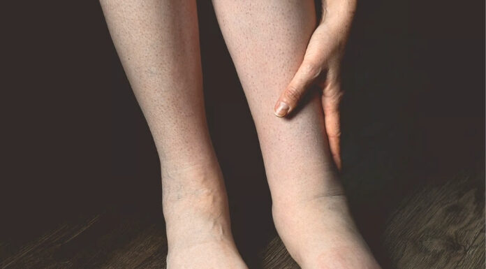 Swollen Legs and Ankles: When It’s a Heart Failure Warning Sign — and When It Isn’t’ Swollen Legs and Ankles
