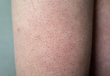 The “Invisible” Keratosis Pilaris: Why Your Skin Feels Like Sandpaper But Looks Clear The “Invisible” Keratosis Pilaris