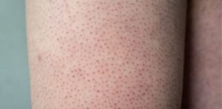 The “Invisible” Keratosis Pilaris: Why Your Skin Feels Like Sandpaper But Looks Clear The “Invisible” Keratosis Pilaris