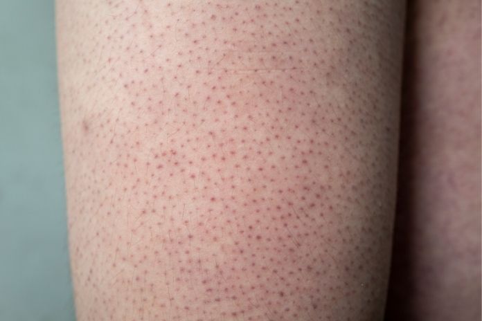 The “Invisible” Keratosis Pilaris The “Invisible” Keratosis Pilaris