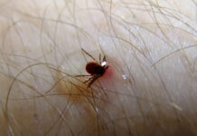 Tick Bite: Symptoms, Risks, and What to Do After You’ve Been Bitten Tick Bite Symptoms Risks and What to Do After Youve Been Bitten