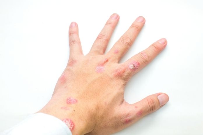 What Guttate Psoriasis Looks Like