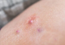 When “Cleanliness” Isn’t the Cure: Why Bacteria Aren’t the Cause of Your Hidradenitis Suppurativa When Cleanliness Isn’t the Cure