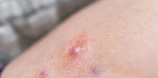 When “Cleanliness” Isn’t the Cure: Why Bacteria Aren’t the Cause of Your Hidradenitis Suppurativa When Cleanliness Isn’t the Cure