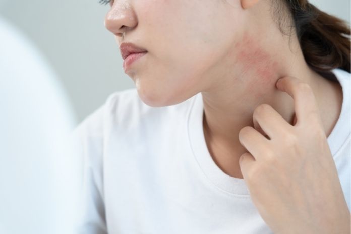 When Itching After Sunburn Could Signal Something More Serious