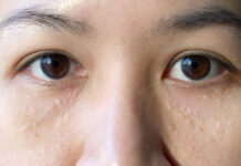 White Bumps Under Your Eyes? Your Anti-Wrinkle Cream Might Be to Blame White Bumps Under Your Eyes