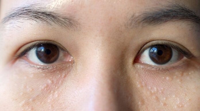 White Bumps Under Your Eyes? Your Anti-Wrinkle Cream Might Be to Blame White Bumps Under Your Eyes