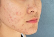 Why Am I Still Breaking Out at 35? The Truth About Adult Hormonal Acne Why Am I Still Breaking Out at 35