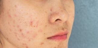 Why Am I Still Breaking Out at 35? The Truth About Adult Hormonal Acne Why Am I Still Breaking Out at 35