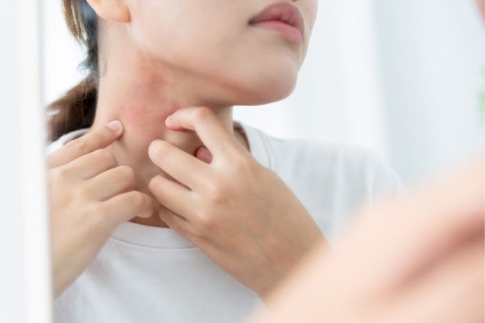 Why Strep Throat Can Trigger a Skin Rash