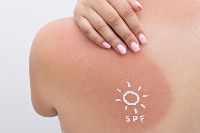 Why Sunburn Cream Can Sometimes Make Itching Worse