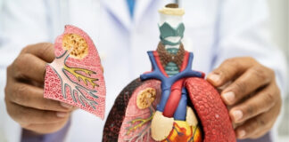 7 Skin Symptoms That Could Signal Lung Cancer — and When to See a Doctor 7 Skin Symptoms That Could Signal Lung Cancer and When to See a Doctor