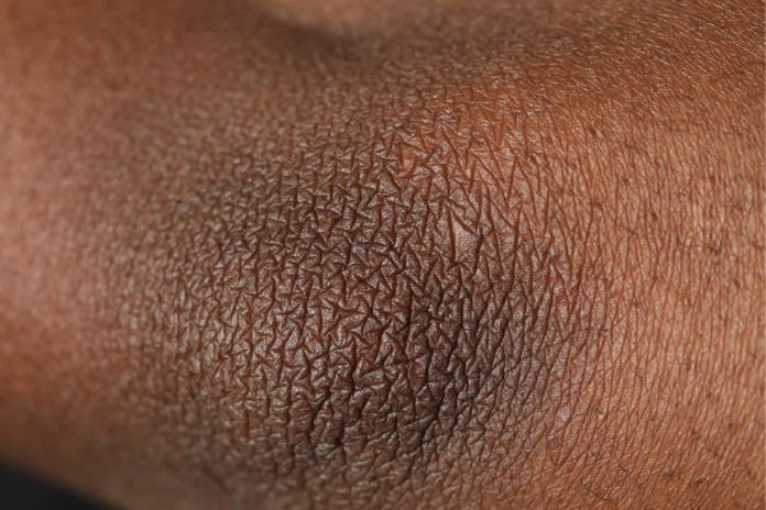 Acanthosis Nigricans