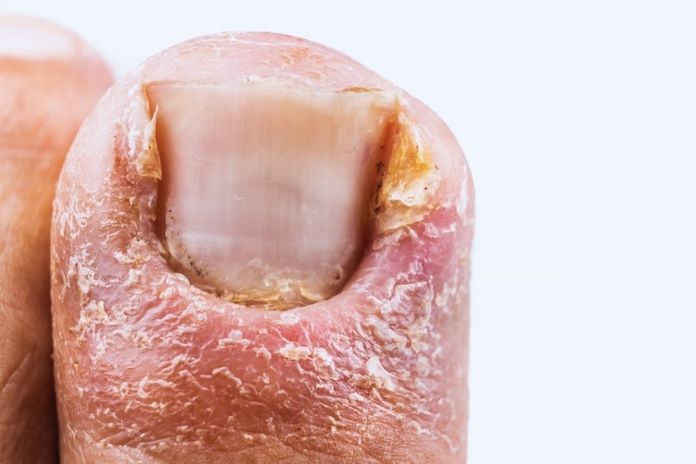 Acrokeratosis Paraneoplastica