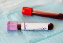 Blood Tests for Heart Disease: Beyond Cholesterol — What Markers Really Matter? Blood Tests for Heart Disease Beyond Cholesterol