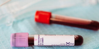 Blood Tests for Heart Disease: Beyond Cholesterol — What Markers Really Matter? Blood Tests for Heart Disease Beyond Cholesterol