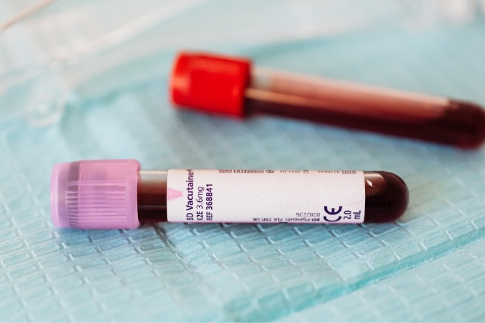 Blood Tests for Heart Disease Beyond Cholesterol Blood Tests for Heart Disease Beyond Cholesterol