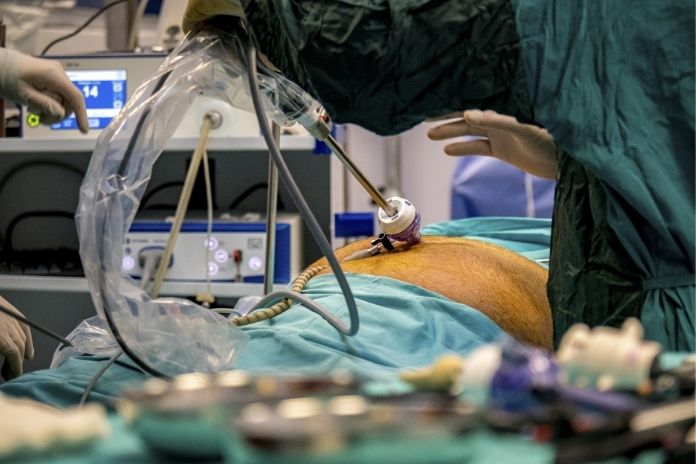 Bypass Surgery Recovery Timeline Bypass Surgery Recovery Timeline