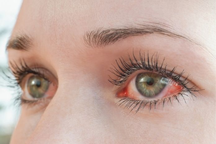 Can Allergy Eye Symptoms Become Serious